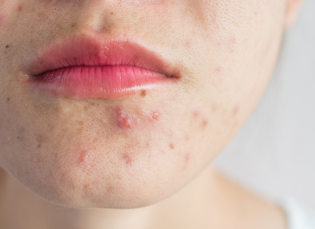 Chin Strap Acne: Why Your Jawline Flares Up In Season (and How to Protect It)