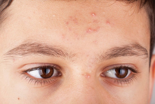 Riding Helmet Acne: Why Equestrians Break Out Under Their Helmets (and How to Protect Your Skin)